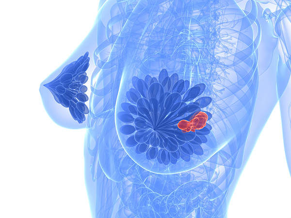 #UQ researchers  may have found a way to improve treatment of triple-negative breast cancer.
#UQResearch from @SaunusJ @Path_4theFuture @ReshmaShakya @amymccart @UQMedicine @UniofAdelaide @UniAdelSciences.

tinyurl.com/y93gayru