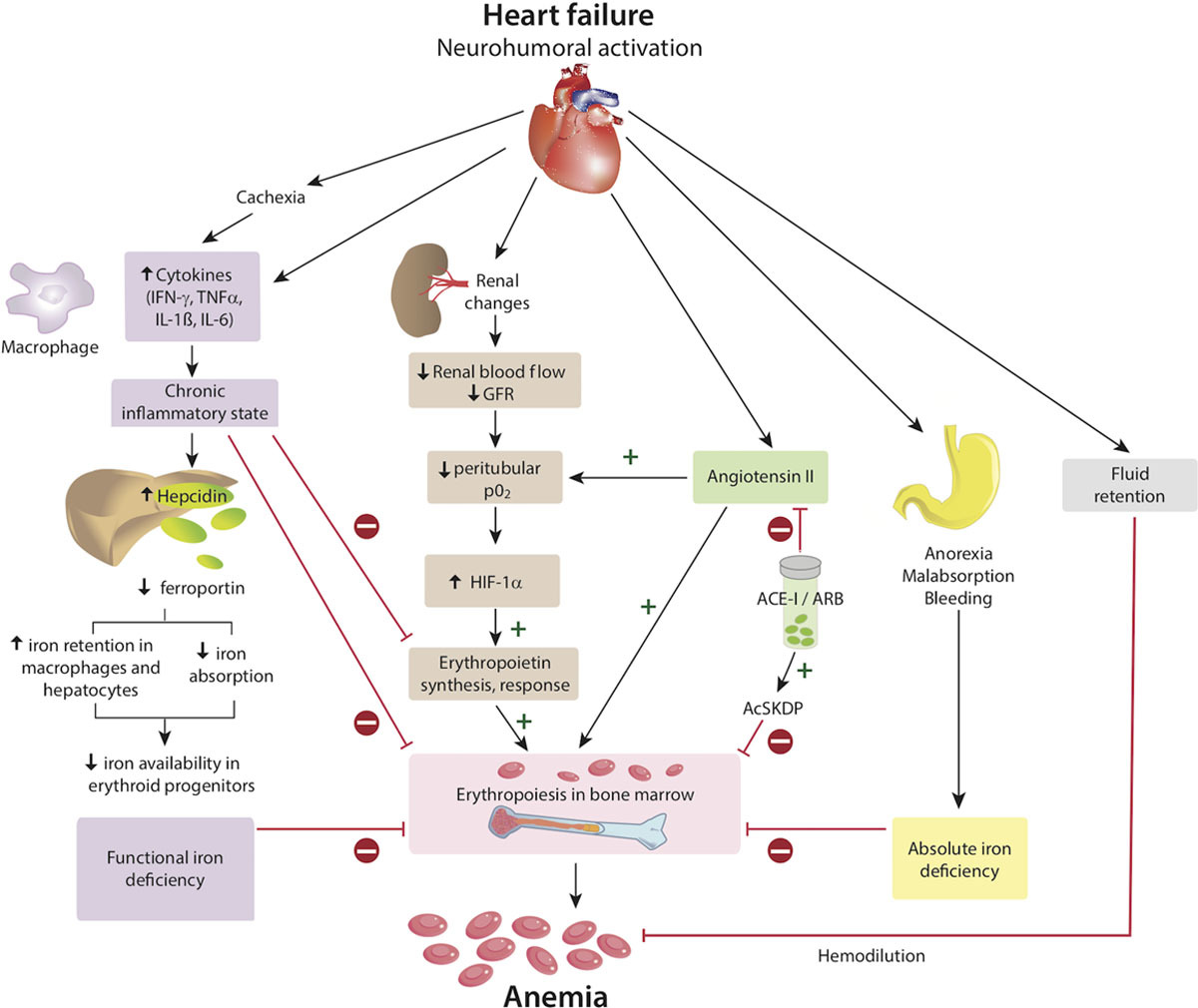 3/Turns out all these factors play a role! Some brief specifics:Inflamm -> ↑hepcidin -> ↑sequestration ↓gut absorpDilution (acute exacerbation)↓Fe (hepcidin)CKD (EPO stimulation from ↓renal pO2 blocked by inflamm)Graphic ( https://bit.ly/2A5BA41 )