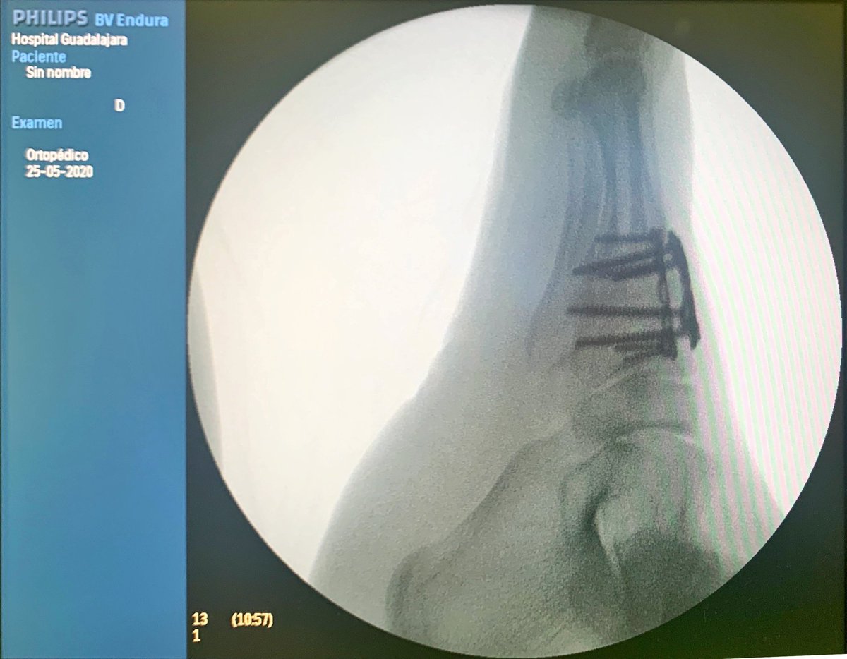 DeborahGonzlez7's tweet photo. Lisfranc day‼️
.
.
Caso Dra @nuriplus 
.
.
#pieytobillo #footandanklesurgery #foot #ankle #lisfrancinjury @semcpt @secotsecot @setla_es https://t.co/cbaiMmwpGc