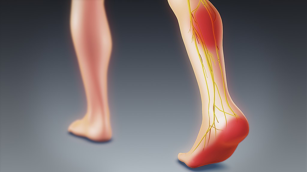 Gohealthtipss's tweet photo. Sciatica is a term used to describe nerve pain. It originates in the lower back, radiates deep into the buttock, and travels down the leg.
Read More here about Sciatica: https://t.co/2pO68NZ4Xs
#Sciatica #backpain #guestpost #healthytips #medication #Painrelief https://t.co/HLEKOKO6Mg