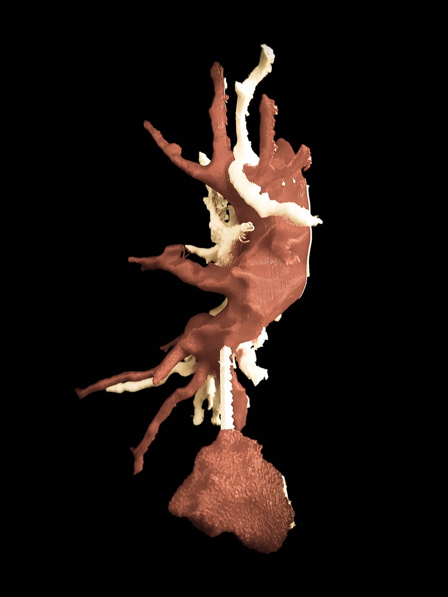 saludtecnolab's tweet photo. #Thoracicsurgery #ThoracicSurgeons #LungCancer #sublobarResection #3Dmodel #model3D #3Dprinting #3Dprinted @3DSlicerApp #meshmixer @HospitalJaen #Jaen https://t.co/EfaBXYpg1e