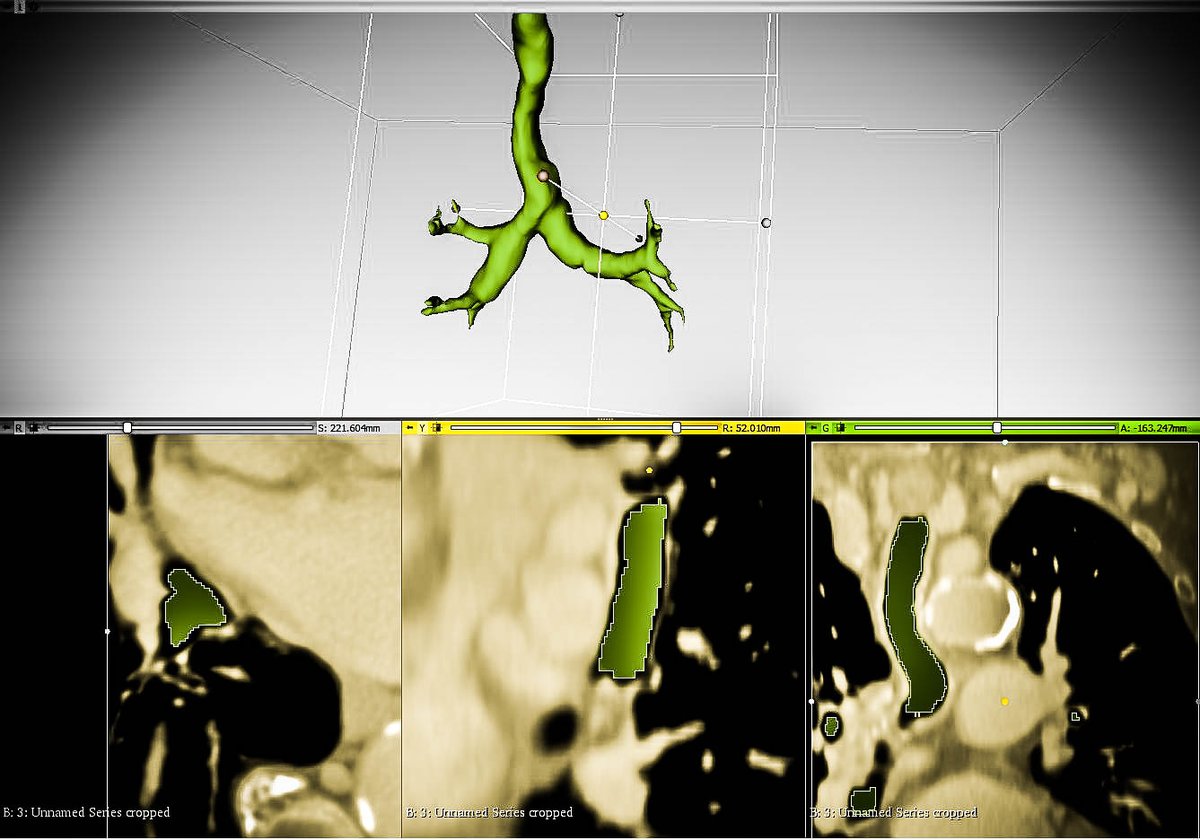 saludtecnolab's tweet photo. #Thoracicsurgery #ThoracicSurgeons #LungCancer #sublobarResection #3Dmodel #model3D #3Dprinting #3Dprinted @3DSlicerApp #meshmixer @HospitalJaen #Jaen https://t.co/veizRHXBG0