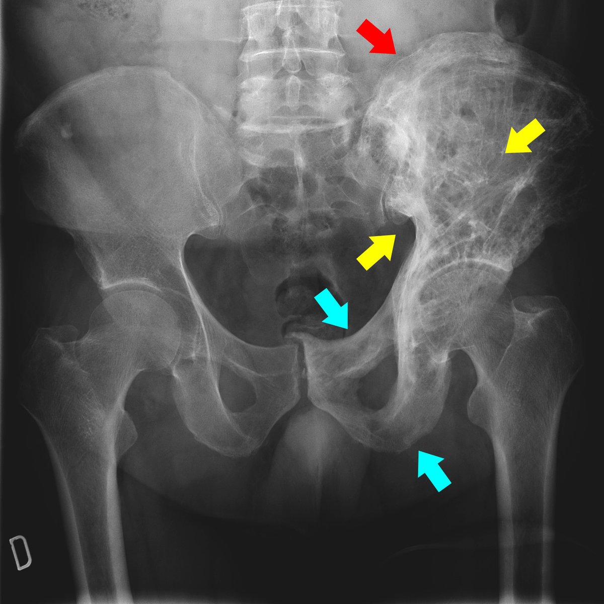 EMEUNET's tweet image. #ImagingQuizzes #Case17 A 60-year-old male patient presented to the Rheumatology clinic with pain in the left hip area. Hip radiography shows trabecular thickening in the ilium (yellow arrow) and pubis (blue arrows) with marked thickening of the iliac crest (red arrow).