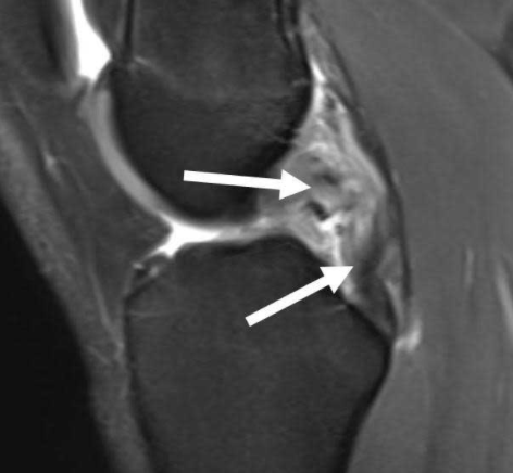 thekneedoc's tweet photo. Dr. LaPrade discusses how to read knee #MRI of #PLCinjury. The #PosterolateralCorner of the #knee is comprised of three main stabilizers; the fibular collateral ligament, the popliteus tendon and the popliteofibular ligament. https://t.co/WIdKBIeZJZ https://t.co/jVa97Vc3wB