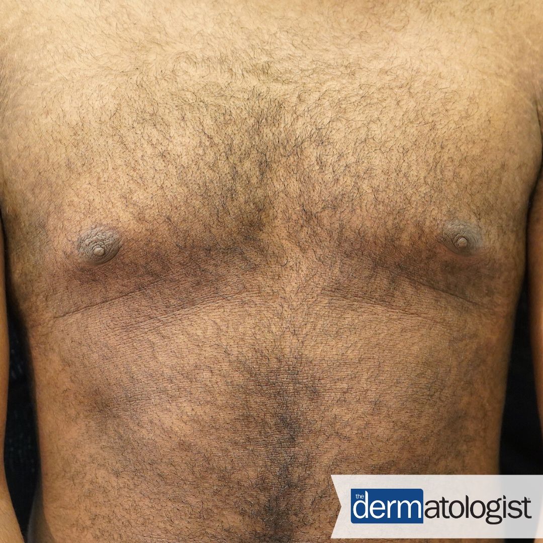 TheDermEditor's tweet photo. This 16yo Pt presented with hyperpigmented patches with minimal overlying scale in a confluent pattern on the chest and abdomen. #dermtwitter, do you know the #DermDx? Test yourself: https://t.co/m11etzSkob https://t.co/gZg82JXoj1