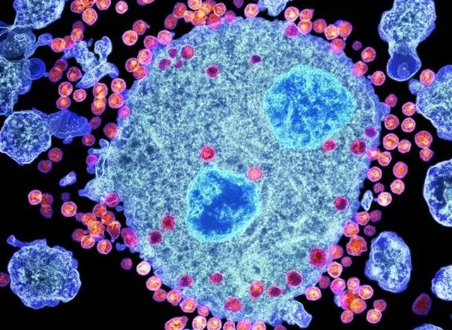 Fissac_es's tweet photo. 📢 La pandemia por COVID-19 ha hecho pasar a un segundo plano una extraordinaria noticia.

🔬 Un estudio reciente publicado en Lancet informa de un paciente que lleva 30 meses libre de sida tras un innovador tratamiento, lo que representaría su cura.

👉 https://t.co/c5ataiBfpC https://t.co/QcTx5YqH6U