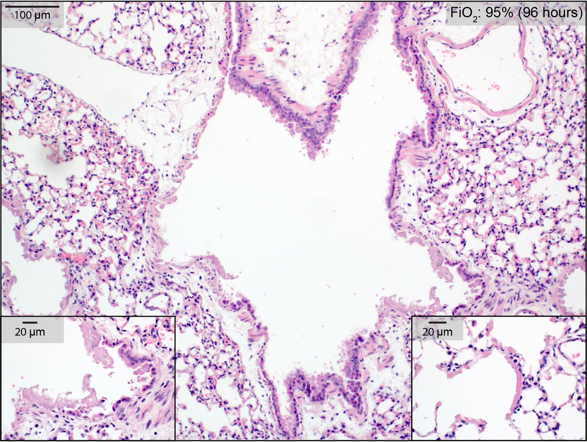 He was describing ARDS (w/ cor pulmonale), 200 years before we named it. If he'd had microscopy, he'd have seen epithelial necrosis, hyaline membranes: diffuse alveolar damage. Same injury pattern that COVID causes. (Image from my lab: healthy mouse, 95% FiO2 for 4 days.)3/n