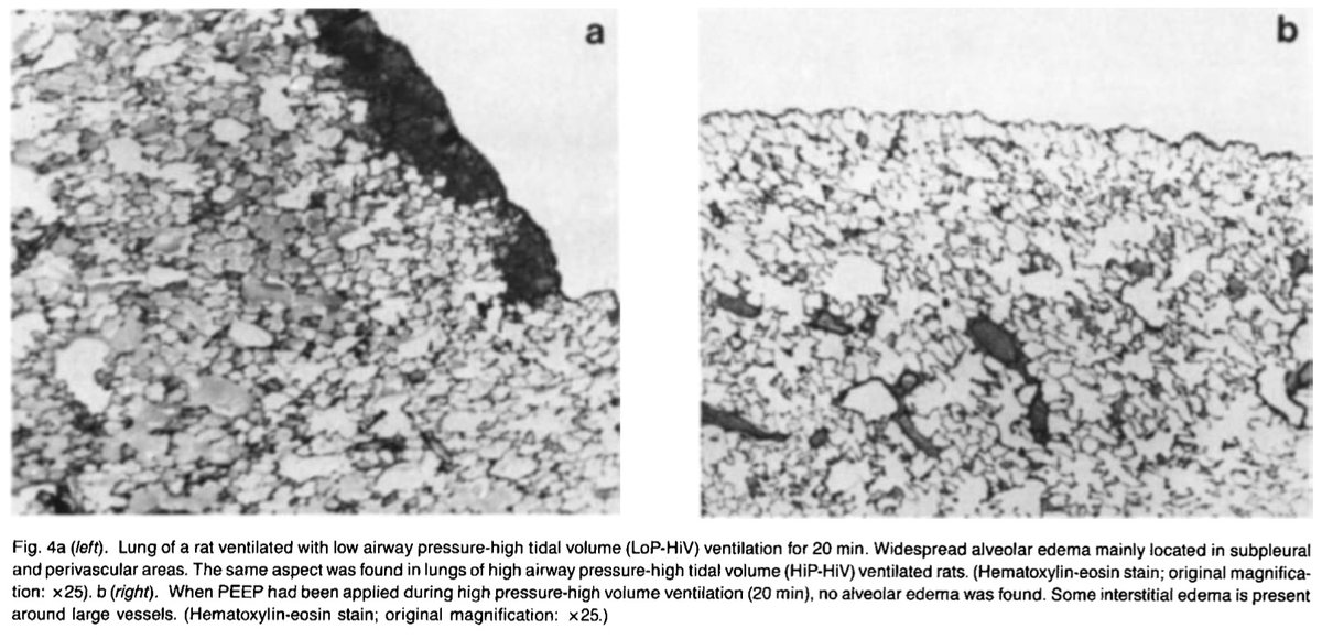 If you ventilate healthy animals with high pressures (w/ a vent) or high volumes (w/ an iron lung), you cause... diffuse alveolar damage. Again, the same pattern of injury we see in COVID lungs. Ventilators can cause ARDS.(Image from  https://www.ncbi.nlm.nih.gov/pubmed/3057957 ... 1988!)8/n