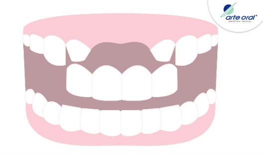 Arte_Oral's tweet photo. Conoce los tratamientos dentales que Arte Oral tiene para recuperar tu sonrisa de la pérdida de dientes. Ingresa aquí: https://t.co/UjVfAoOjgx
.
.
.
.
#RehabilitaciónOral #ImplantesDentales #PérdidadeDientes https://t.co/coYdmzBqo6 https://t.co/slDdzo2mxb