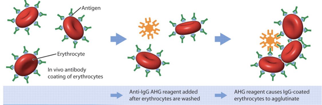 RBCs are washed to remove unbound antibodies. Anti-IgG (or complement) reagent is added. If antibody is present on RBCs—> agglutination! Antibodies are then eluted off to determine specificity. 3/n