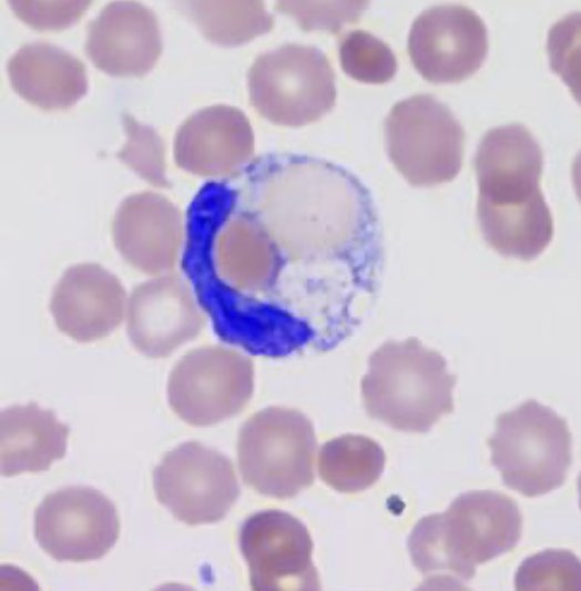 In addition to a positive antibody test, peripheral blood smear may reveal erythrophagocytosis (try saying that three times fast!) Although this is seen with monocytes in other entities, neutrophil mediated erythrophagocytosis is rarely seen outside of PCH. Pretty, no? 9/n