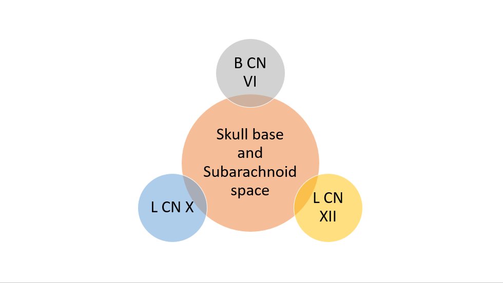 Video shows bilateral abducens palsies (B CN VI) Drawing shows L palate weakness (L CN X) Image shows L tongue atrophy (L CN XII). The involvement of the eye movements means that it cannot only localize to the medulla.  6/