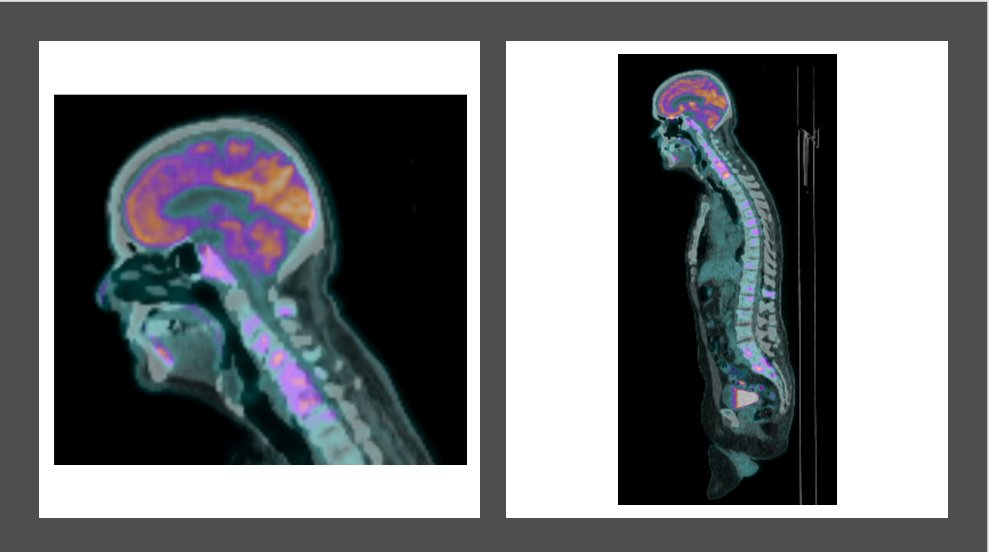 PET shows multiple bony lesionsLP is normal. Negative cytology.8/