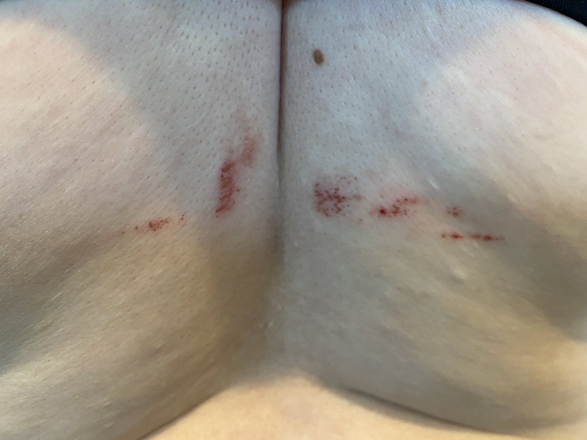 Victoria ECY on X: In other news, that's 13 miles worth of sports bra  chafing! I'll take this over blisters any day though. And I love my sports  bra - it's an