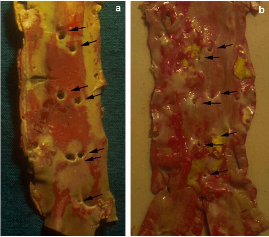 francisholway's tweet photo. Según esta revisión del tema, los mismos factores que tapan arterias y generan infartos y ACV, tabaquismo y colesterol elevado, tapan las arterias lumbares que nutren los discos de la columna, deshidratándolos y generando dolores lumbares: https://t.co/jpOwRsr55z https://t.co/OXqmpjVvy1