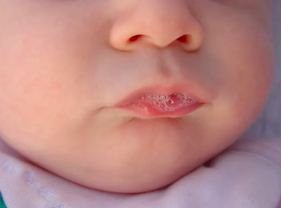 PHILTRUMThe fold of skin between your nose and upper lip is the philtrum. It's also called the medial cleft, but it comes from the ancient Greek for love charm.