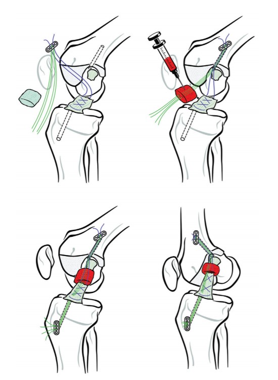 Does bridge-enhanced ACL repair have the same outcome and failure rate as autograft ACL reconstruction in young patients?  #ACL #ACLrepair #ACLtear #EducateThePatient
ow.ly/TWUR50zJmy8