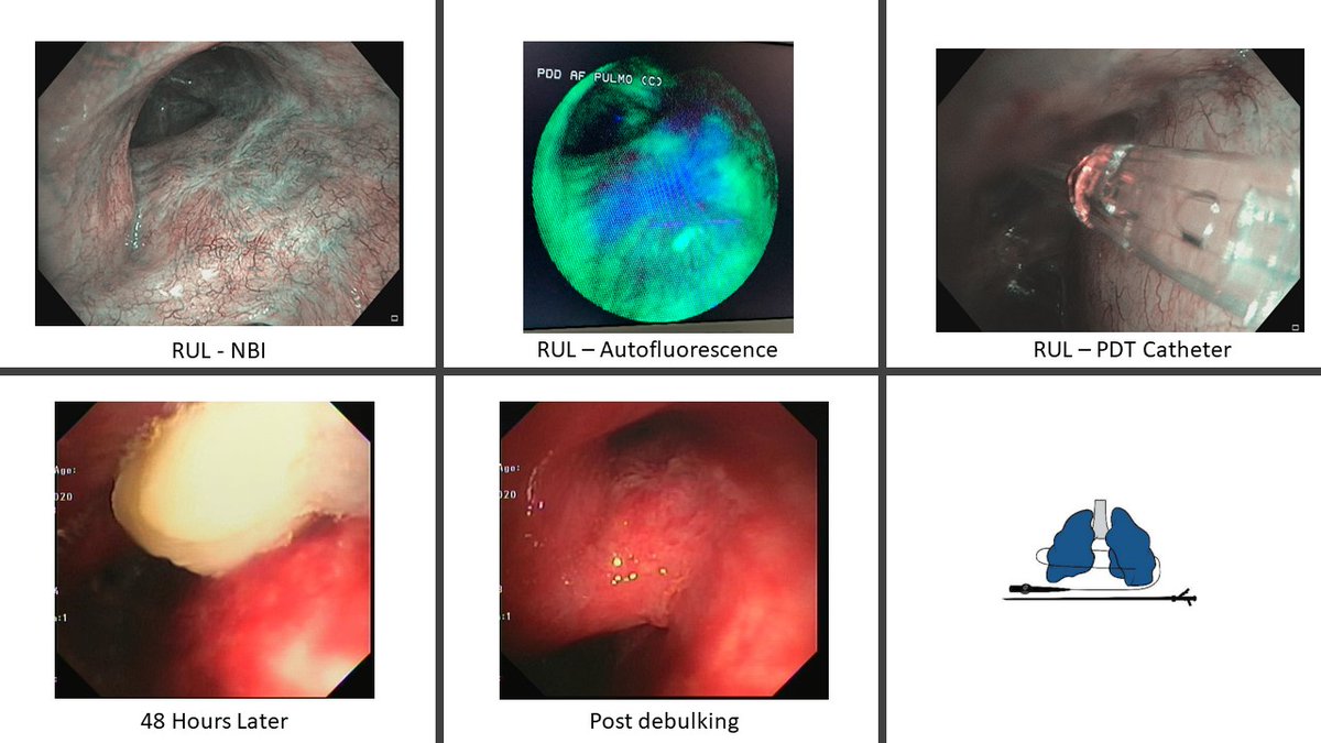 non obstructive squamous cell carcinoma seen on narrow band imaging, autofluorescence. Undergone photodynamic therapy with 48 hours mucosal necrosis followed by debulking.