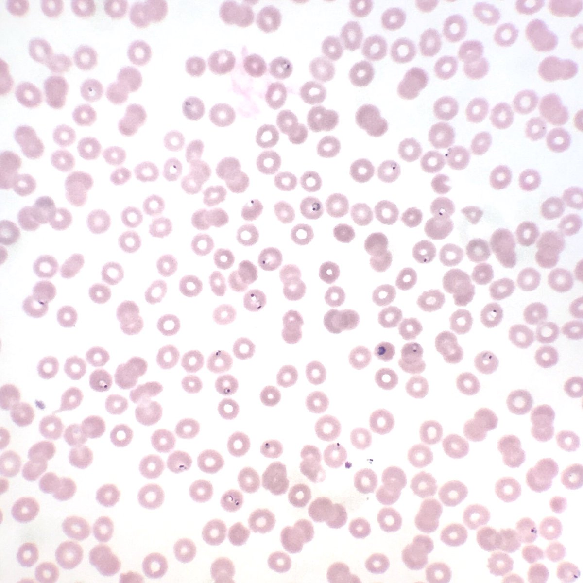 MFeelyDO's tweet image. Really enjoyed listening to the recording of @ParasiteGal’s #CAPVirtualPath lecture. I even dug out my secret stash of peripheral smears.