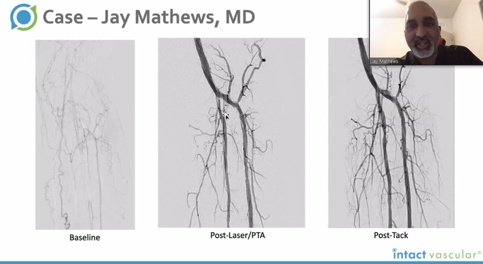 JayMathewsMD's tweet photo. Great discussion on tonight's "Tack Chat" webinar. Will definitely do more as we push the limits of this exciting technology @IntactVascular #dissectionsmatter #tackitup #clifighters https://t.co/Ha3lJG9Crh