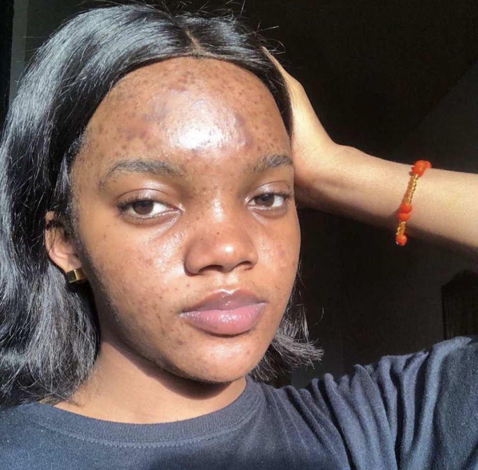 So what is hyperpigmentation? It can look like little dark marks, diffuse discoloration, or darker patchy areas. There are different types of hyp., but 2 that POC and more specifically WOC are more prone to are post-inflammatory hyp. (PIH) & melasma. What kind(s) do you have?