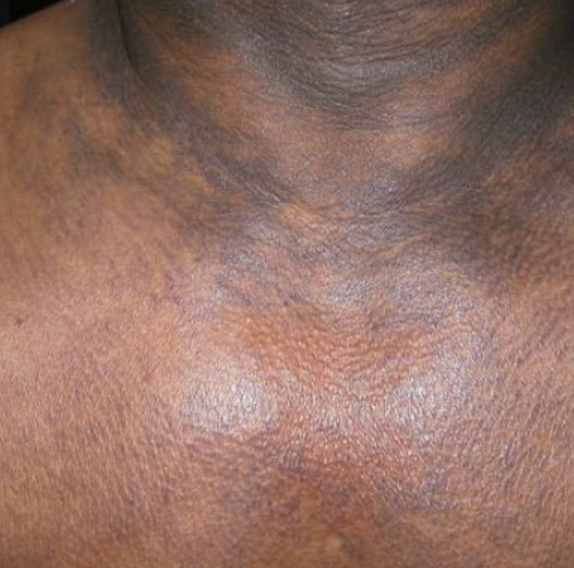 Let's break these down a little more: PIH - appears after trauma/inflammation. This includes bug bites, cuts, burns, and inflammatory skin conditions like eczema, psoriasis, acne, rosacea, KP (chicken skin), razor bumps (also strawberry legs). What causes your PIH?