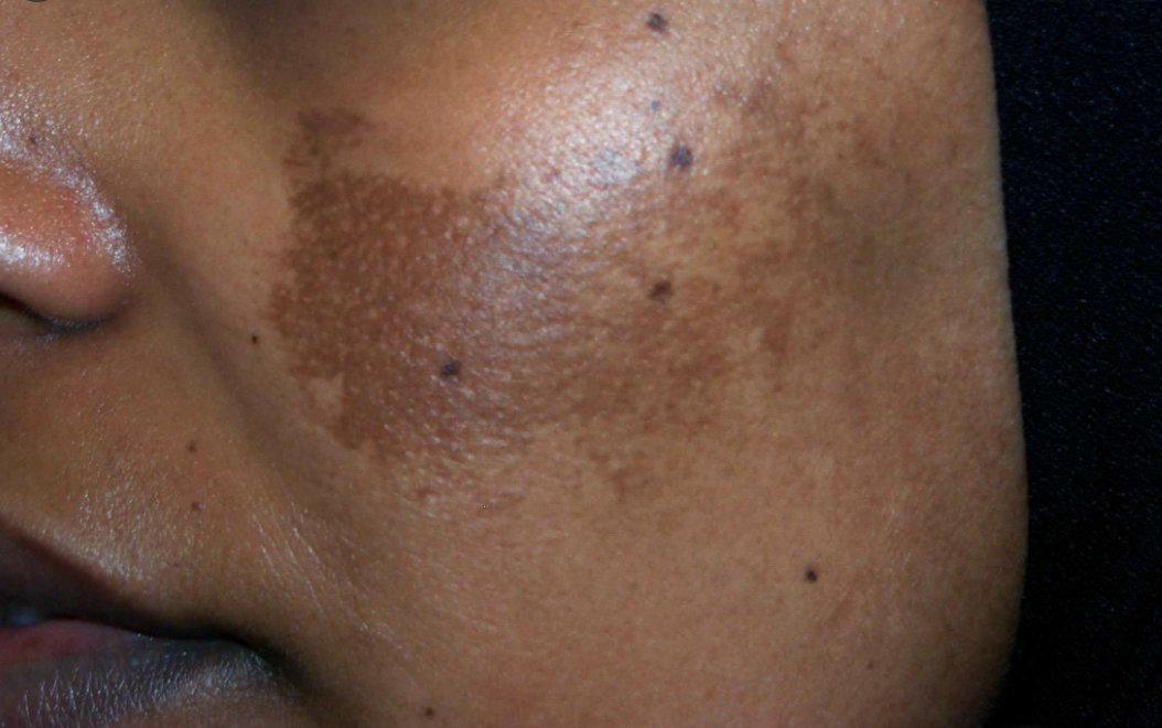 Melasma - occurs in women because of changes in hormone levels (estrogen and progesterone), often triggered by sun exposure. Looks like larger, more spread out dark patches and is most often found on your face. It often looks like a mask or a mustache/beard.