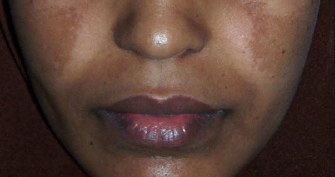 Melasma - occurs in women because of changes in hormone levels (estrogen and progesterone), often triggered by sun exposure. Looks like larger, more spread out dark patches and is most often found on your face. It often looks like a mask or a mustache/beard.