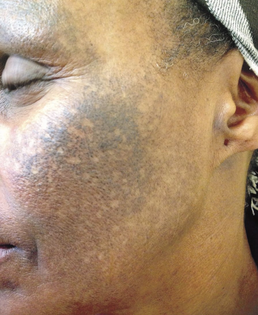 That's how ingredients like hydroquinone, considered the gold standard of hyp. treatment but which disproportionately causes ochronosis (shown below) in WOC, slips through the cracks in skincare and dermatology.