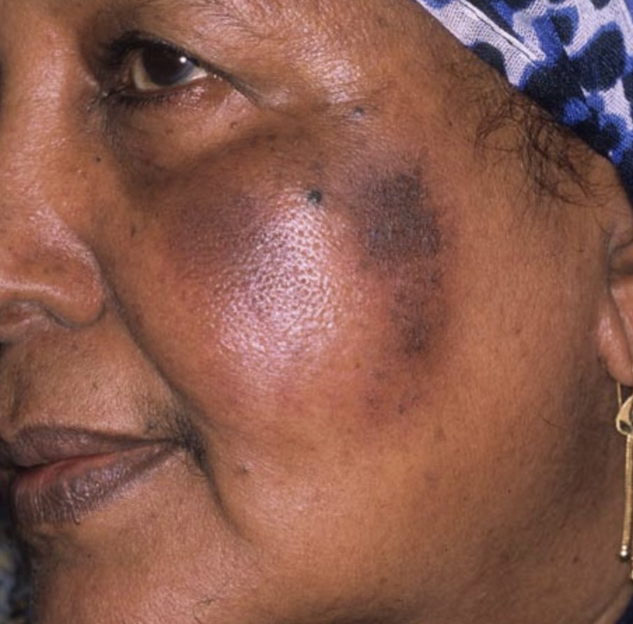 That's how ingredients like hydroquinone, considered the gold standard of hyp. treatment but which disproportionately causes ochronosis (shown below) in WOC, slips through the cracks in skincare and dermatology.