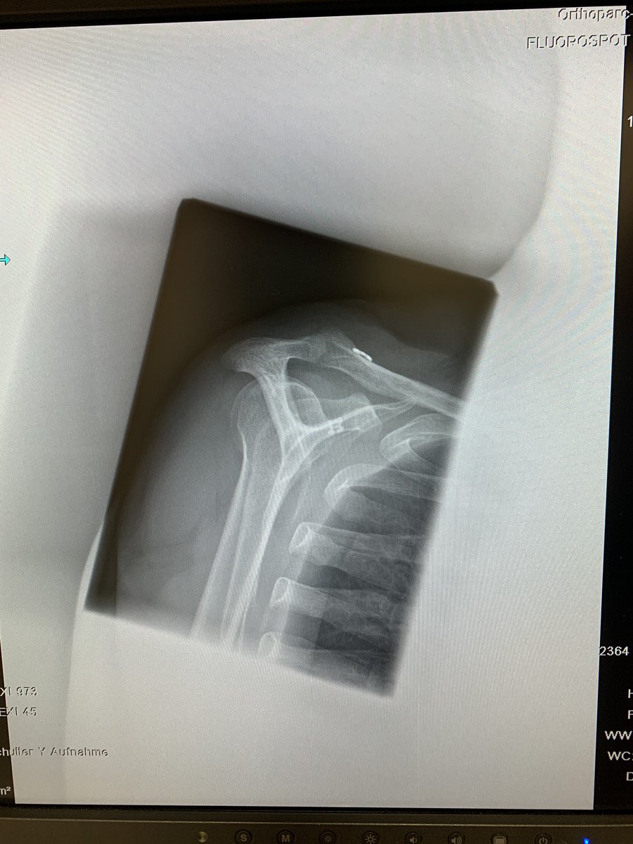 dirk_tenner's tweet photo. Ok, fixed and stable... even 10 min on the bike this morning ! Thanks a lot to my colleague @BeitzelKnut fixing my AC-joint perfectly.. not an easy case - rockwood V 💪👍 https://t.co/69OEGUJFXV