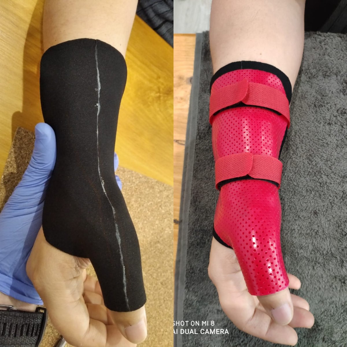 CEIMa18's tweet photo. Combinamos!! Neopreno y orfit.
Para tratar un pacientes de https://t.co/xAFzQbQL8a Quervain.
Comodidad y resusltados
#terapiademano #quervain #rehabilitacion #handsurgery #terapiaocupacional #fisioterapiaespecializada #Barcelona https://t.co/B0aAMzweQW