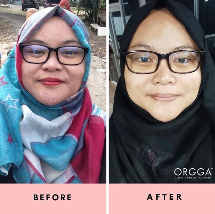 asyida_'s tweet photo. 😱😱😱😱 Guna product selamat, maka selamat lah skin anda. Gitttuuuuu 😉 https://t.co/HEM4agdHDU