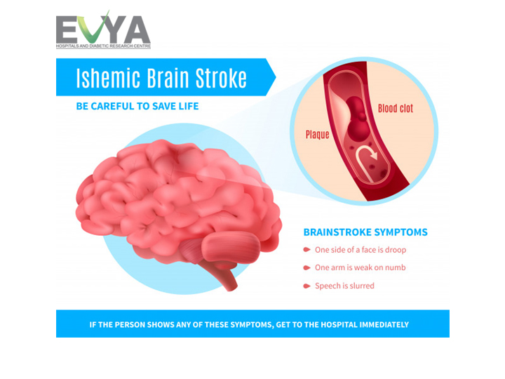 evyahospitals's tweet photo. The blockage reduces the blood flow and oxygen to the brain, leading to damage or death of #brain_cells. #Cerebral ischemia is caused by disruption of the blood supply, and thus oxygen, to the brain, particularly the cerebrum.
Call: 9133335421
visit@ https://t.co/dZkuHmB0ep https://t.co/Uq09gHPyo1