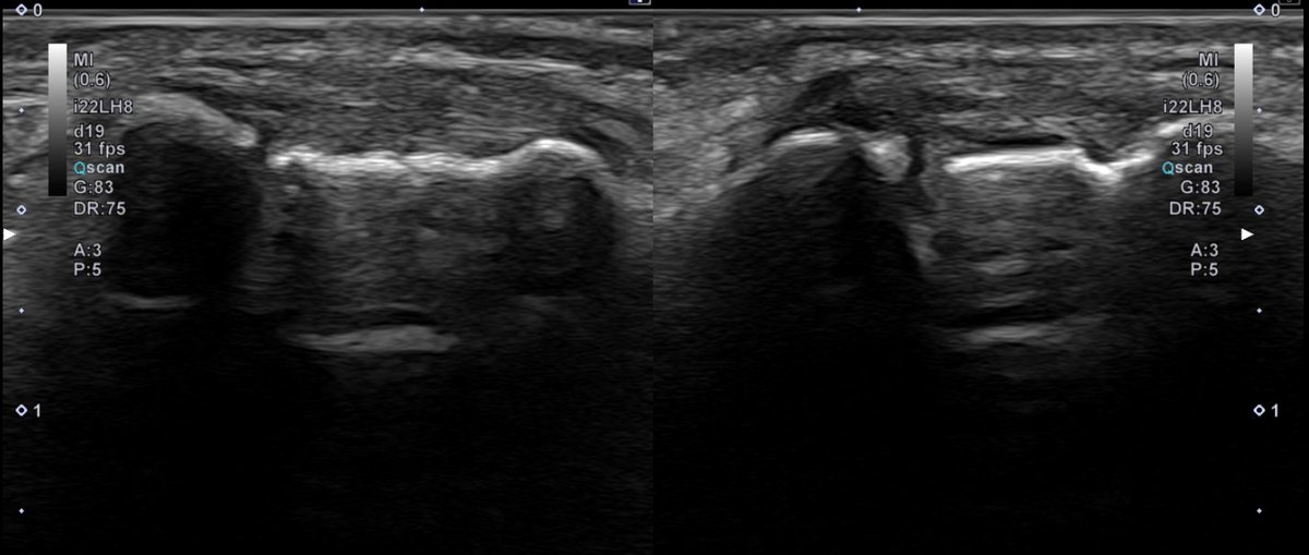 inigoiri's tweet photo. Male, 47 y, mechanic. dorsal luxation of IFP of 5 finger  6 months ago. Since then, acute sharp pain lateral side of IFP with some movements. Normal ROM. Less pain last two months. MRI informed as normal (no access to images). US Image comparing (right is painful one). Thoughts? https://t.co/MBScSniVC7