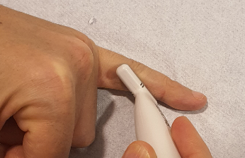 inigoiri's tweet photo. Male, 47 y, mechanic. dorsal luxation of IFP of 5 finger  6 months ago. Since then, acute sharp pain lateral side of IFP with some movements. Normal ROM. Less pain last two months. MRI informed as normal (no access to images). US Image comparing (right is painful one). Thoughts? https://t.co/MBScSniVC7