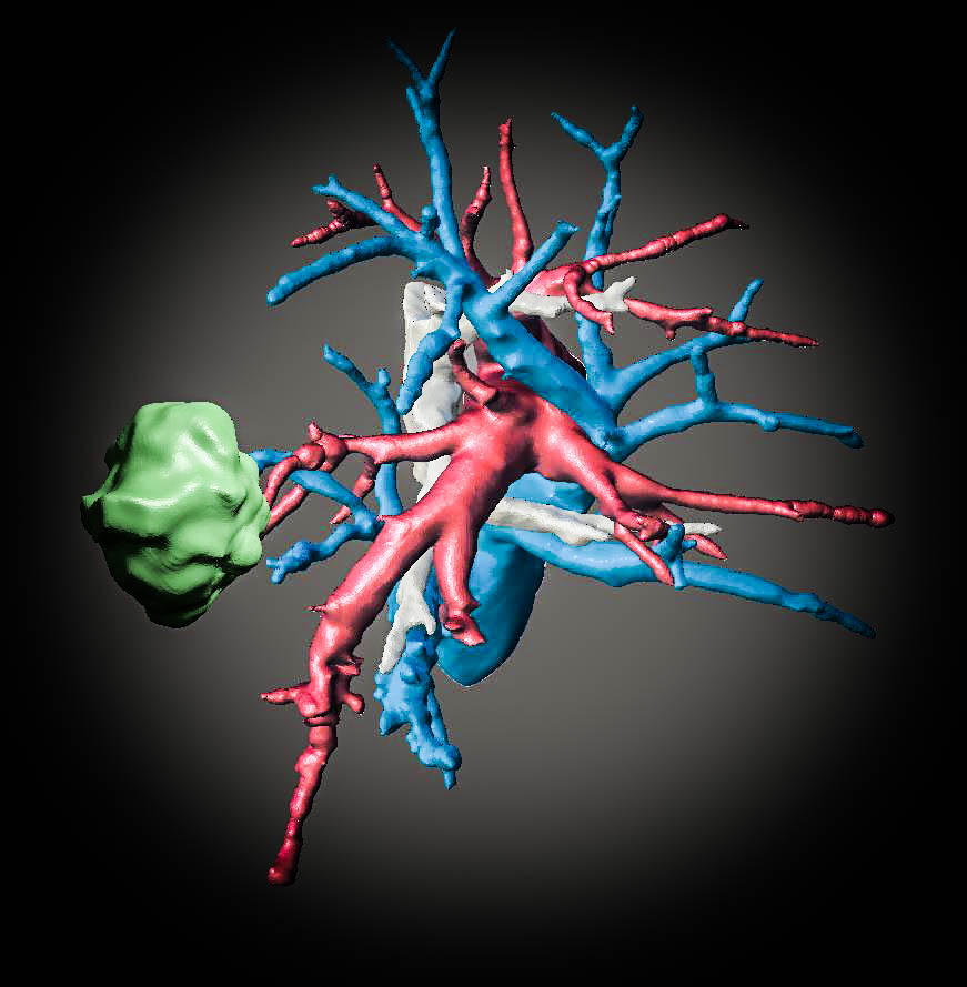 saludtecnolab's tweet photo. #Thoracicsurgery #ThoracicSurgeons #LungCancer #sublobarResection #3Dmodel #model3D #3Dprinting #3Dprinted @3DSlicerApp #meshmixer @HospitalJaen #Jaen https://t.co/sEwsyRwCup