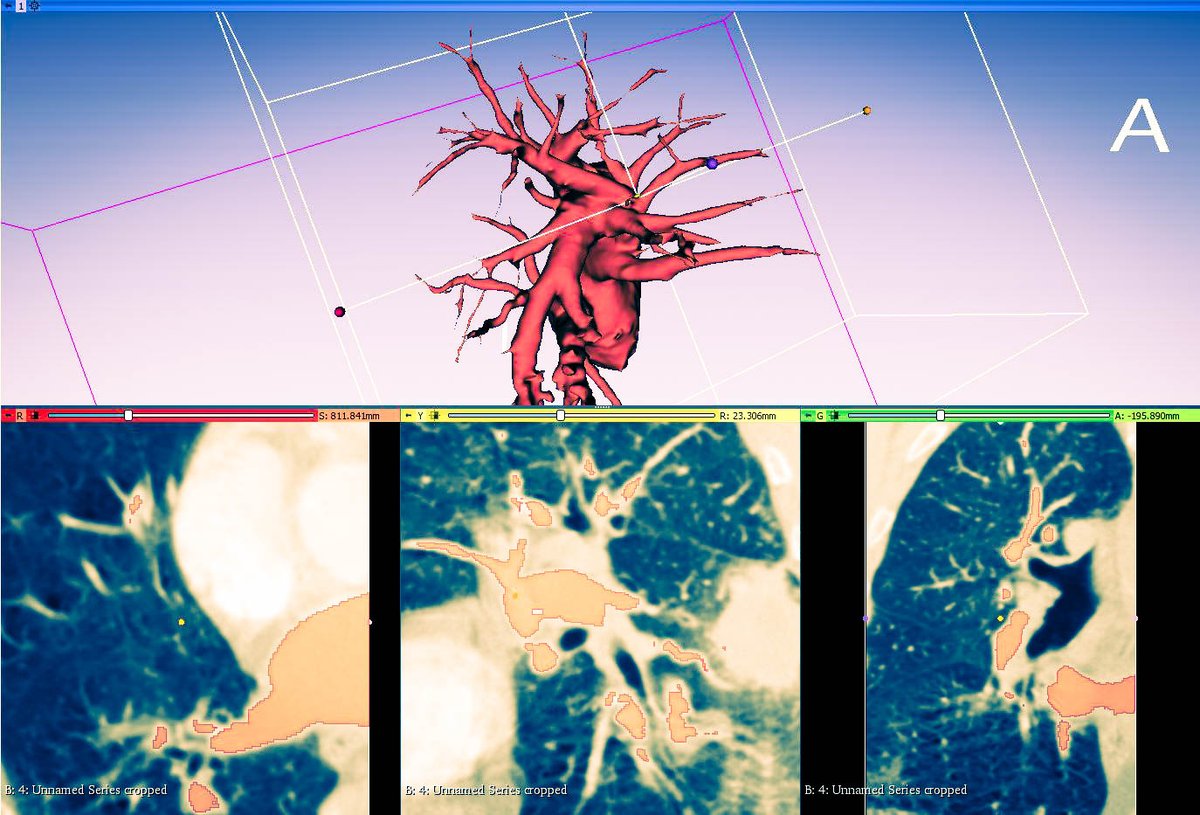 saludtecnolab's tweet photo. #Thoracicsurgery #ThoracicSurgeons #LungCancer #sublobarResection #3Dmodel #model3D #3Dprinting #3Dprinted @3DSlicerApp #meshmixer @HospitalJaen #Jaen https://t.co/sEwsyRwCup