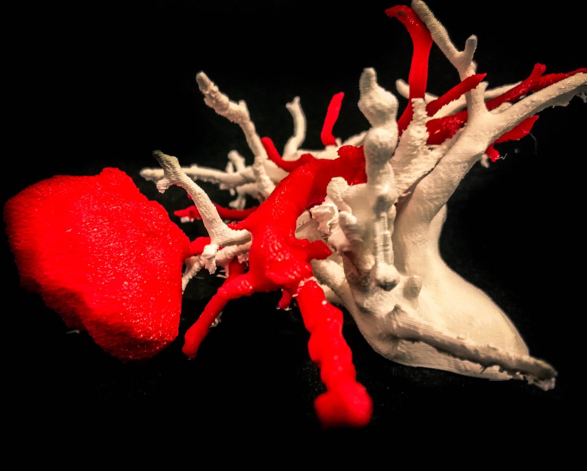 saludtecnolab's tweet photo. #Thoracicsurgery #ThoracicSurgeons #LungCancer #sublobarResection #3Dmodel #model3D #3Dprinting #3Dprinted @3DSlicerApp #meshmixer @HospitalJaen #Jaen https://t.co/sEwsyRwCup