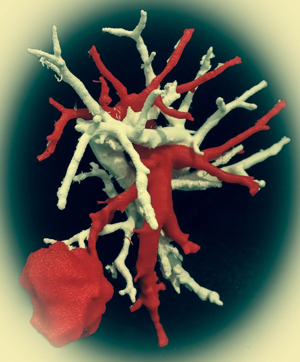 saludtecnolab's tweet photo. #Thoracicsurgery #ThoracicSurgeons #LungCancer #sublobarResection #3Dmodel #model3D #3Dprinting #3Dprinted @3DSlicerApp #meshmixer @HospitalJaen #Jaen https://t.co/sEwsyRwCup