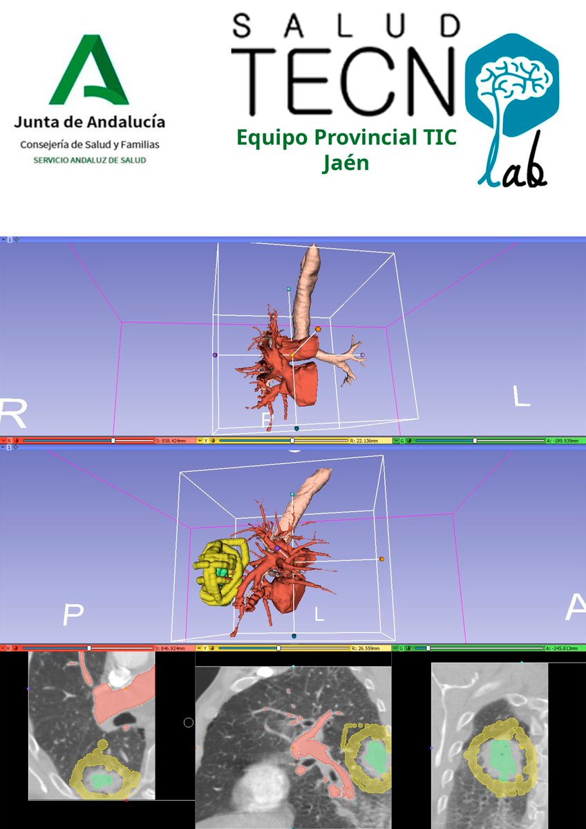 saludtecnolab's tweet photo. #Thoracicsurgery #ThoracicSurgeons #LungCancer #sublobarResection #3Dmodel #model3D #3Dprinting #3Dprinted @3DSlicerApp #meshmixer @HospitalJaen #Jaen https://t.co/qkLyEI3nhW