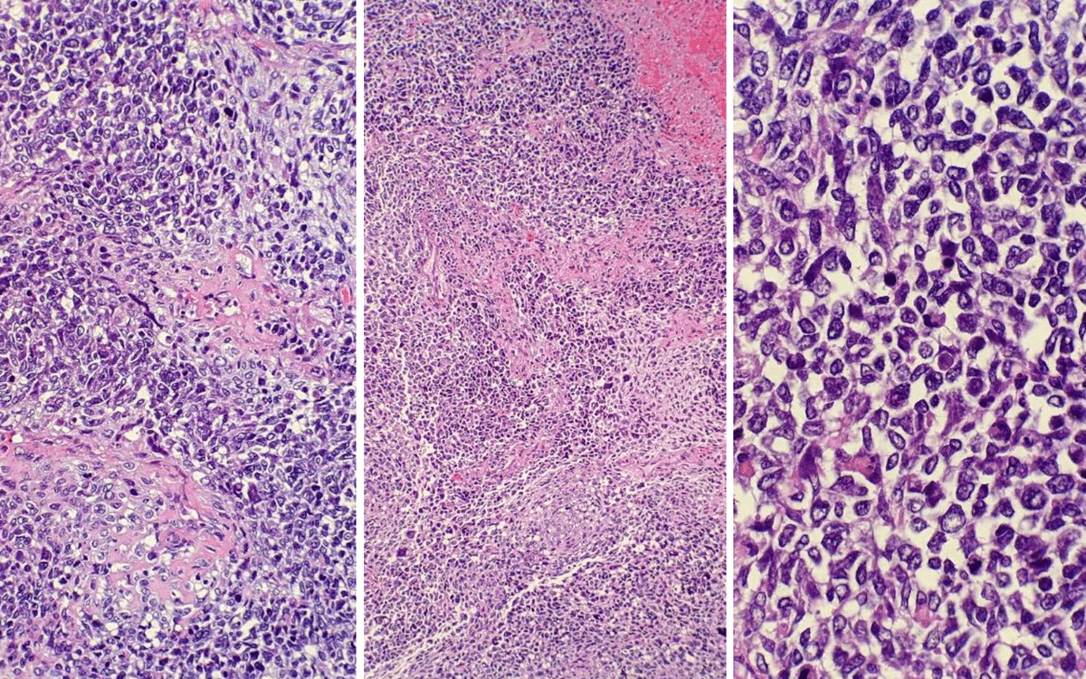 TexPathol's tweet photo. Anaplastic Sarcoma of the Kidney with DICER1 mutation from a female child. DICER1 mutations are also seen with pleuropulmonary blastoma, multinodular goiter, PTC, cystic nephroma, Wilms’ tumor, ovarian tumors, and embryonal rhabdomyosarcoma. #pathology #pedipath @sarah_glogowski https://t.co/nraVpROCSW