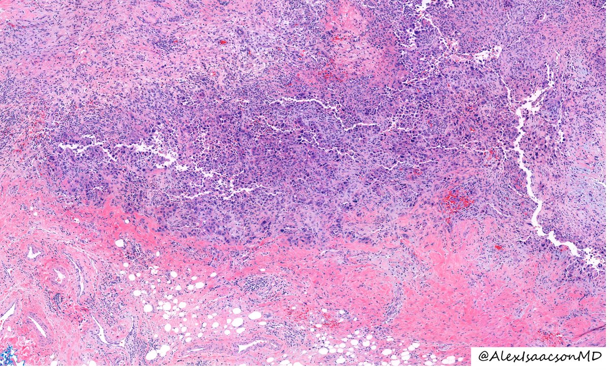 AlexIsaacsonMD's tweet photo. It is #MolaviFriday @UIPathology, a resident-led slide conference based on the classic #pathology textbook! Last week, @danpelletiermd led a great review of this #BSTpath entity.

This is a subcutaneous lesion on the arm of a 20 year old.  What is your differential? https://t.co/PTKGwHLvvh