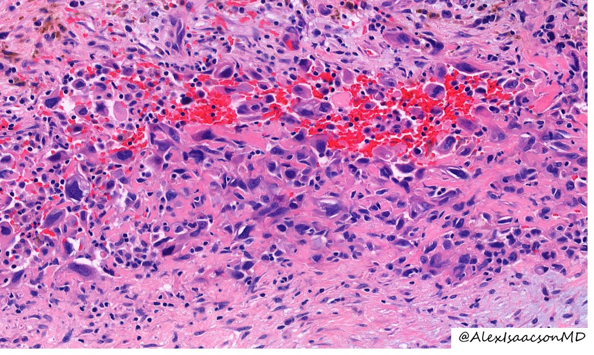 AlexIsaacsonMD's tweet photo. It is #MolaviFriday @UIPathology, a resident-led slide conference based on the classic #pathology textbook! Last week, @danpelletiermd led a great review of this #BSTpath entity.

This is a subcutaneous lesion on the arm of a 20 year old.  What is your differential? https://t.co/PTKGwHLvvh