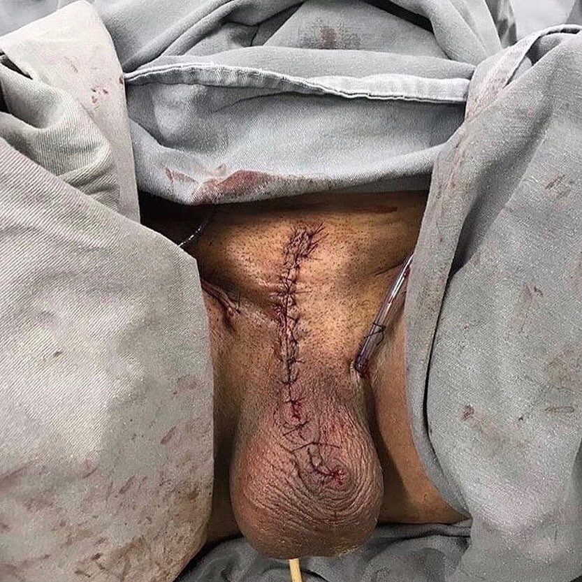 FGI___'s tweet image. PENECTOMY - Removal of the penis.
It is the most common and most effective way to treat penile cancer. The goal is to remove the entire tumor. In total penectomy, the entire penis is removed, including the roots that extend to the pelvis.