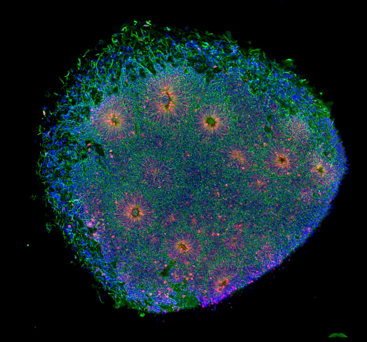 ViraIefremova's tweet photo. Today is #TSCAwarenessDay 
I'm trying to figure out more details about the mechanism of the #TSC with #organoids aka #minibrains. 
🔹 8 in 100.000 is affected
🔹 #TSC is a genetic disorder with no cure that causes
non-cancerous tumors
🔹 2/3 of individuals have no family history https://t.co/3tGJ6NfdTl