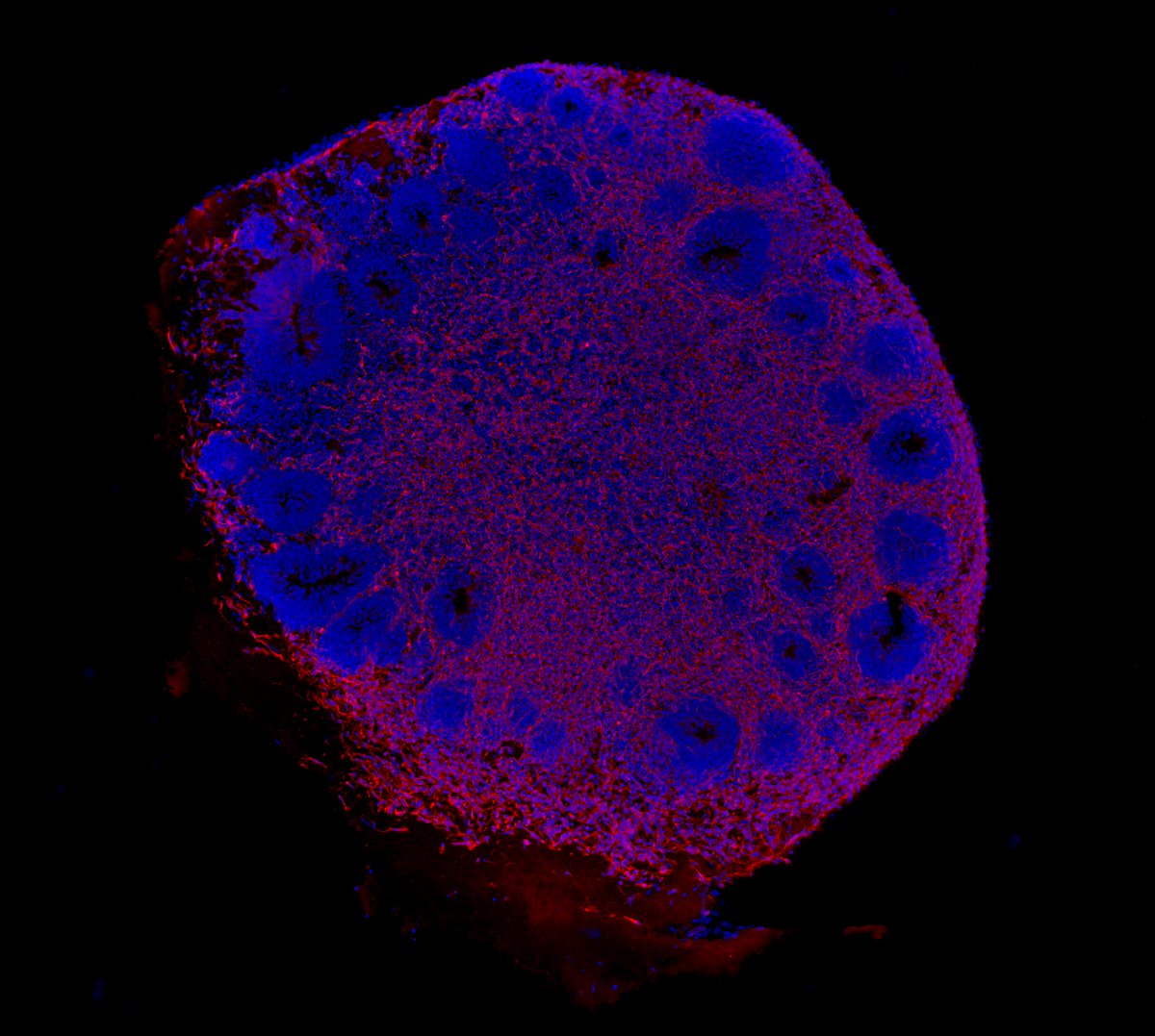 ViraIefremova's tweet photo. Today is #TSCAwarenessDay 
I'm trying to figure out more details about the mechanism of the #TSC with #organoids aka #minibrains. 
🔹 8 in 100.000 is affected
🔹 #TSC is a genetic disorder with no cure that causes
non-cancerous tumors
🔹 2/3 of individuals have no family history https://t.co/3tGJ6NfdTl