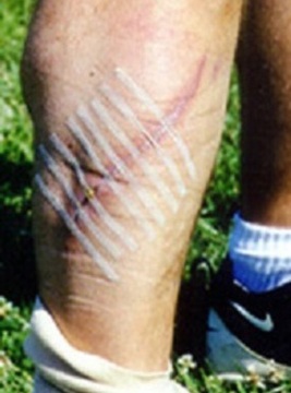 Don't play volleyball in a danger zone and end your game looking like this! What do we do to give you a Safer Game &amp; Larger Playing Zone? We have designed a one-of-a-kind ground anchoring system.
cobravolleyball.com/volleyball-net…
#volleyball #volleyballplayer #volleyballteam