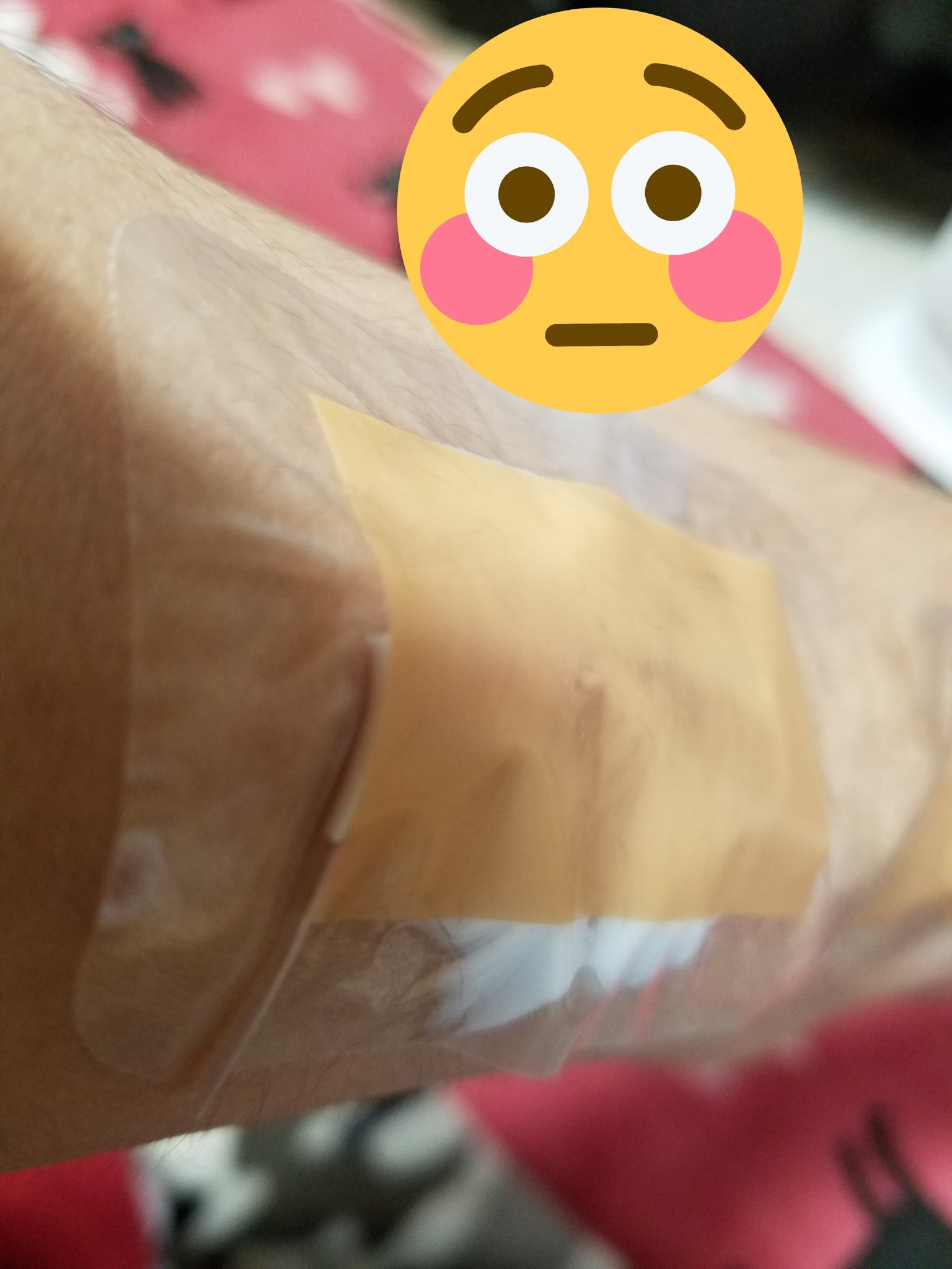 おやき 量を間違えたかハミ出た 透析 穿刺 エムラクリーム T Co Xrc0rneaay Twitter