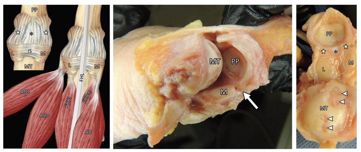dflemosmd's tweet photo. Fresh out of the oven...a gorgeous @RadioGraphics article with beautiful drawings, dissections, and high res MR images of the 1st MTP Joint...congrats to Jim Hallinan, @mskbradiologist @CBChung_ucsd and other coauthors @UCSDImaging #mskrad a “must” read https://t.co/4cVtqRgWrs https://t.co/o6pQVDMvjw